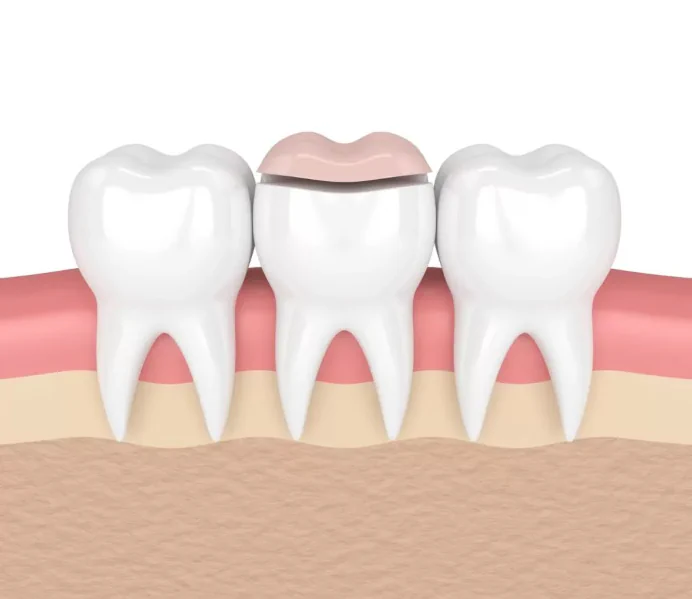 Dental Inlays & Onlays